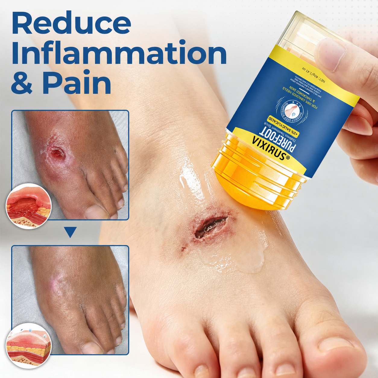 VIXIRUS® PureFoot Diabetes Treatment Stick