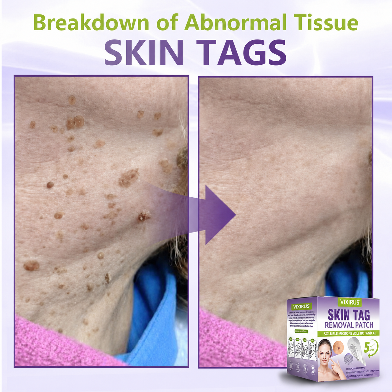 VIXIRUS® Soluble Microneedle Botanical Skin Tag Removal Patch