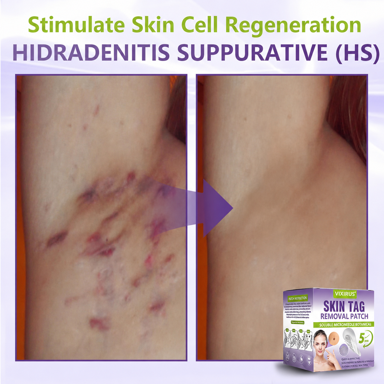 VIXIRUS® Soluble Microneedle Botanical Skin Tag Removal Patch