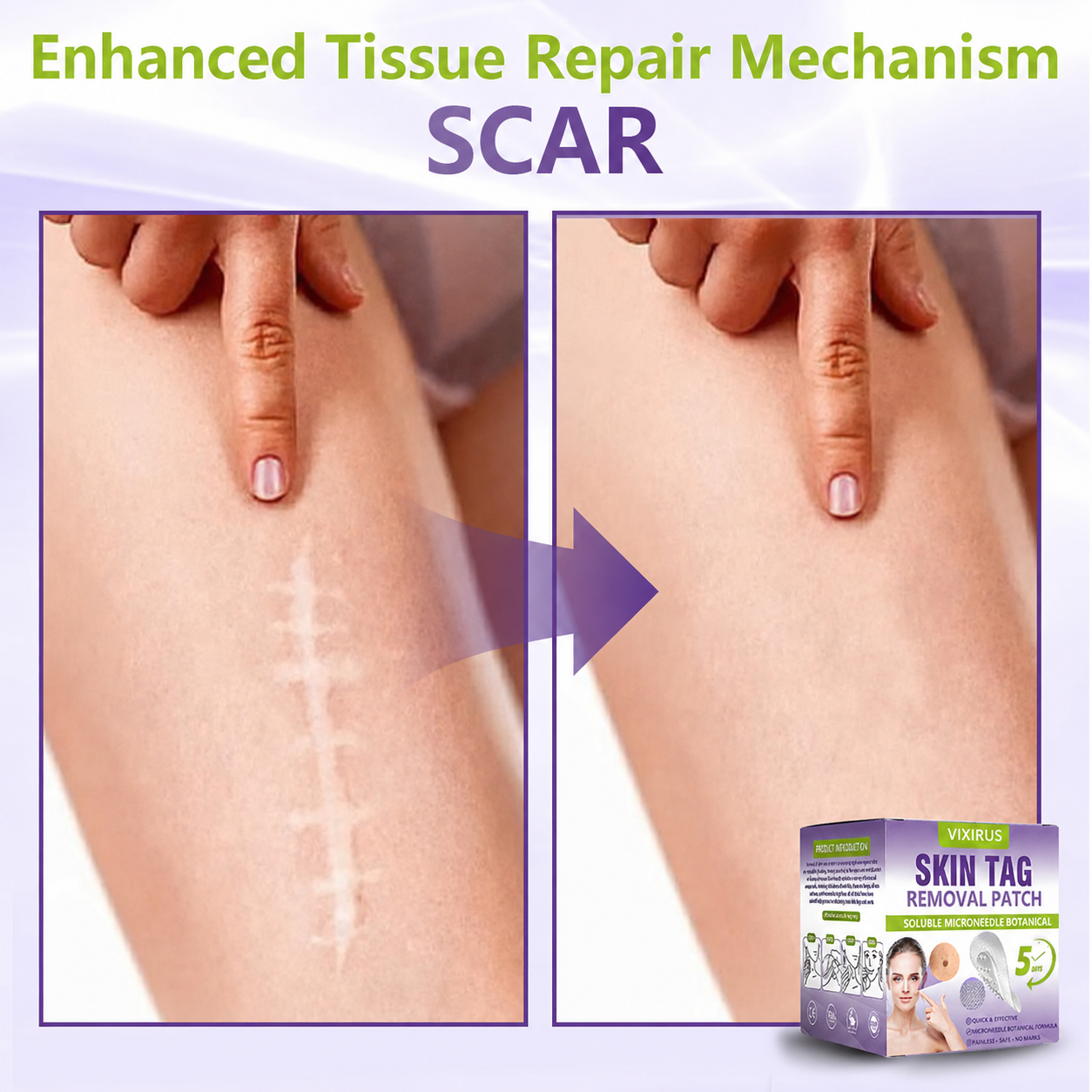 VIXIRUS® Soluble Microneedle Botanical Skin Tag Removal Patch