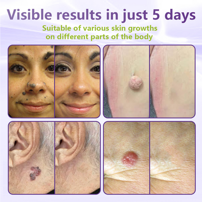 VIXIRUS® Soluble Microneedle Botanical Skin Tag Removal Patch